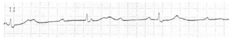 This diagnostic image is a single-lead (Lead II) rhythm strip electrocardiogram (ECG) demonstrating a complete heart block, also known as third-degree atrioventricular (AV) block. The tracing shows complete AV dissociation, characterized by independent atrial and ventricular activity. P waves are present and occur at a regular, faster atrial rate, but they bear no consistent relationship to the QRS complexes; some P waves are superimposed on T waves or the QRS complexes themselves. The ventricular rhythm is maintained by a slow, bradycardic escape rhythm. The QRS complexes are relatively narrow and appear at regular intervals, suggesting a junctional escape origin. This clinical finding is critical for medical students and clinicians to recognize as it indicates a total failure of conduction through the AV node, necessitating urgent clinical intervention such as a permanent pacemaker.