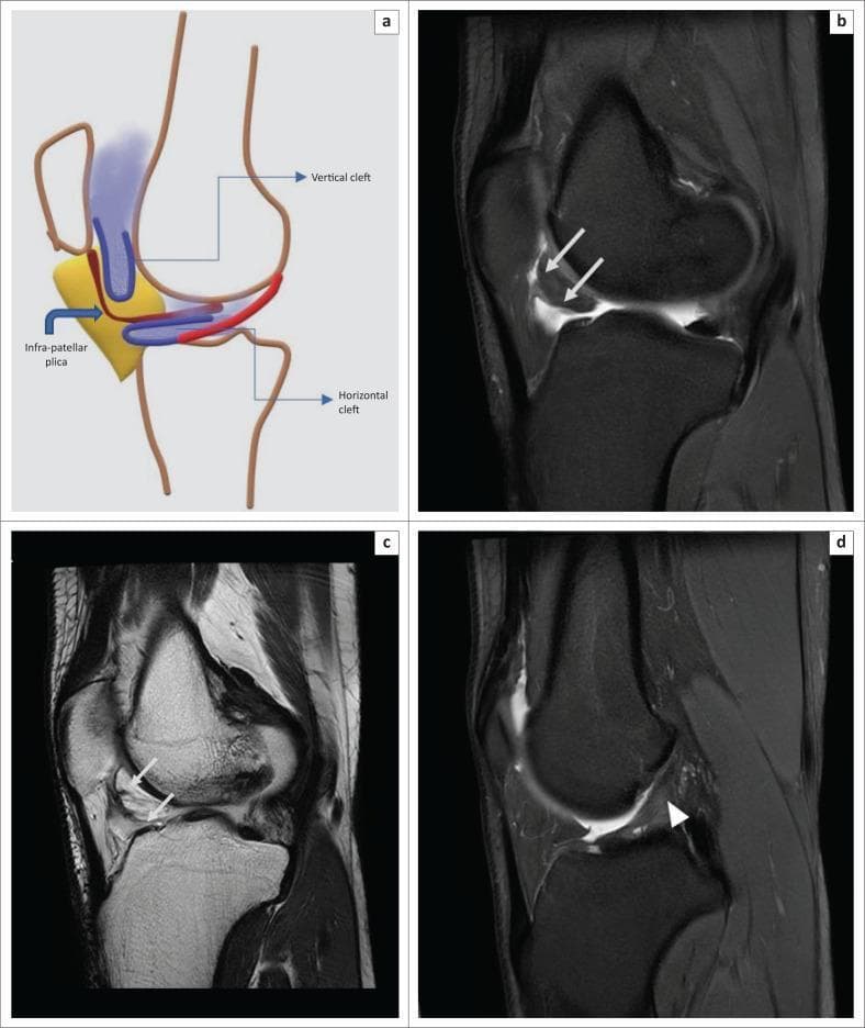 This composite educational resource illustrates the anatomy of normal synovial clefts in Hoffa’s fat pad and a common musculoskeletal pathology. Image (a) is a schematic diagram of the knee in a sagittal orientation, labeling the vertical (supra-Hoffotic) cleft, horizontal (infra-Hoffotic) cleft, and the infrapatellar plica (IPP). Images (b) and (c) provide radiological correlation using oblique sagittal Proton Density Fat-Saturated (PDFS) and T2-Weighted (T2WI) MRI sequences, respectively. They demonstrate hyperintense, smoothly marginated, fluid-filled synovial clefts (white arrows) within the infrapatellar fat pad that are contiguous with the joint fluid, representing normal anatomical variations rather than pathology. Image (d) is a sagittal PDFS MRI highlighting a mild sprain of the anterior cruciate ligament (ACL). A white arrowhead indicates a region of increased signal intensity within the middle third of the ACL, signifying ligamentous injury. This image set is designed for musculoskeletal radiology education, focusing on distinguishing normal synovial structures from intra-articular ligamentous sprains.