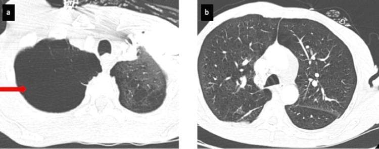 Two axial CT pulmonary angiography (CTPA) slices displayed in a lung window, illustrating chronic obstructive pulmonary disease (COPD) pathology. Image (a) shows a large, well-circumscribed, air-filled bulla in the right apical region, indicated by a red arrow. This bulla causes focal compression of the adjacent lung tissue and significant rarefaction of the vascular markings. Image (b) shows a lower thoracic section demonstrating diffuse, bilateral emphysematous changes. The lung parenchyma exhibits increased lucency, multiple small air-filled lucent spaces, and a reduction in the density and caliber of peripheral pulmonary vessels, creating a 'spongy' texture. These findings are characteristic of extensive centrilobular and paraseptal emphysema. The images provide clinical evidence of severe parenchymal destruction, contributing to decreased gas exchange and potential secondary pulmonary hypertension.
