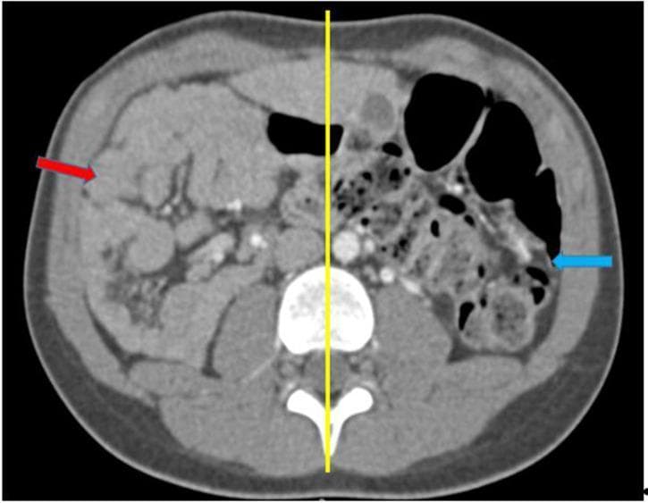 This diagnostic image is an axial contrast-enhanced CT (TDM) scan of the abdomen demonstrating a complete common mesentery, a type of intestinal malrotation. The image shows a distinct anatomical deviation from normal intestinal positioning, highlighted by a yellow vertical bisecting line. The small bowel loops are entirely sequestered on the right side of the abdominal cavity (indicated by the red arrow), while the colon and large bowel segments are located on the left side (indicated by the blue arrow). This non-rotation pattern, where the midgut fails to undergo its normal 270-degree counter-clockwise rotation, results in a narrow mesenteric base. The image is a primary educational tool for radiology and gastroenterology, illustrating the classic presentation of intestinal malrotation in adults or pediatric patients, which carries a clinical risk of midgut volvulus.