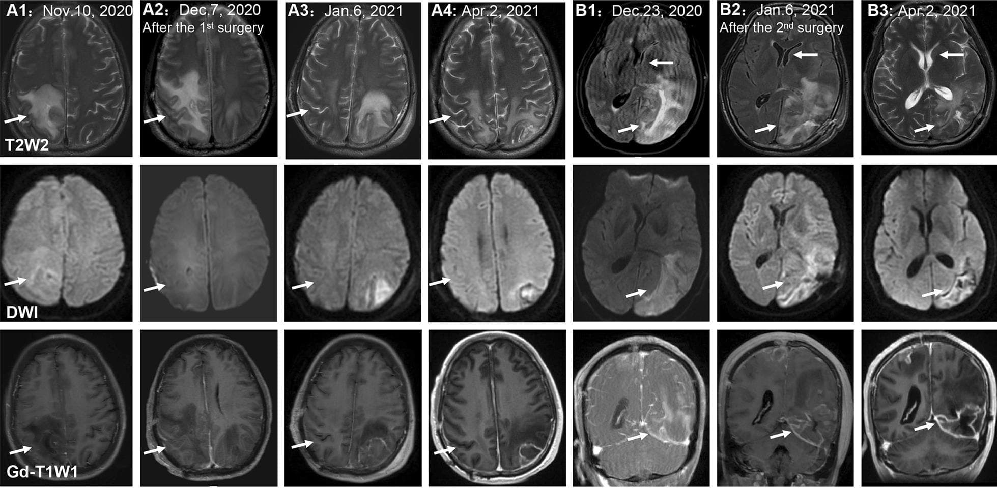 This diagnostic imaging composite displays a series of brain MRI scans illustrating the longitudinal progression of granulomatous amoebic encephalitis (GAE) caused by Balamuthia mandrillaris. The image is organized into two panels (A and B) across three imaging modalities: T2-weighted (T2W2), Diffusion-Weighted Imaging (DWI), and Gadolinium-enhanced T1-weighted (Gd-T1WI).
Panel A (A1–A4) follows a right parietal lobe lesion from initial presentation through post-surgical follow-up. The lesion shows high T2 signal intensity and restricted diffusion on DWI, with peripheral enhancement on Gd-T1WI. Over time (Nov 2020 to Apr 2021), the lesion and associated perilesional edema significantly decrease in size.
Panel B (B1–B3) tracks a subsequent left occipital lobe lesion. Key features include high T2 and DWI signal intensity, marked contrast enhancement, and evidence of a left cerebral subfalcine herniation (indicated by white arrows). Follow-up scans after a second surgery and combined antimicrobial therapy (sulfamethoxazole/trimethoprim, azithromycin, flucytosine, and fluconazole) show gradual stabilization of the lesion and slight improvement of the midline shift. This series demonstrates the characteristic multifocal, infiltrating, and necrotic nature of GAE and its response to intensive medical and surgical management.