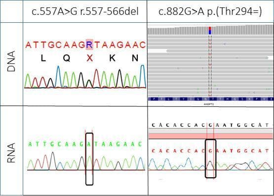 A multi-panel genetic comparison chart illustrating nonsense-mediated mRNA decay (NMD) in the ANGPT2 gene. The image compares DNA sequencing (top row) with RNA sequencing (bottom row) for two specific variants: c.557A>G (a pathogenic splice-site variant) and c.882G>A (a benign marker variant). The DNA column for c.557A>G shows a Sanger sequencing chromatogram with a heterozygous 'R' peak (overlapping A and G signals). In contrast, the corresponding RNA chromatogram shows only a single 'A' peak (wild-type), indicating the mutant transcript is absent. The c.882G>A column displays DNA via a Next-Generation Sequencing (NGS) coverage plot showing heterozygosity (mixed blue/red reads), while the RNA panel utilizes a Sanger chromatogram showing monoallelic expression of the G-allele. Black rectangles highlight the variant sites in the RNA rows to emphasize the loss of the mutant allele. This visual serves as diagnostic evidence of NMD, where premature termination codons lead to the degradation of mutant mRNA transcripts, leaving only the wild-type allele detectable in functional RNA analysis.
