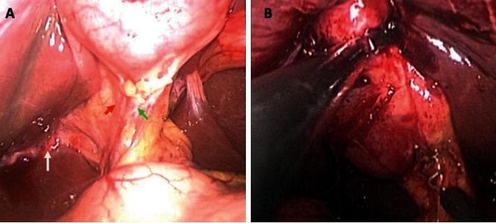 This comparison chart consists of two side-by-side intraoperative laparoscopic photographs (A and B) demonstrating clinical findings during single-incision laparoscopic surgery (SILS) cholecystectomy. View A shows a patient without inflammation, where the peritoneum is thin and transparent. Anatomical landmarks within Calot's triangle are clearly visible before dissection: the cystic artery (red arrow), the cystic duct (green arrow), and Rouviere's sulcus (white arrow). View B depicts a patient with acute cholecystitis, characterized by significant inflammation. The peritoneum is thickened, opaque, and hyperemic, obscuring the underlying anatomy and making the cystic artery and duct difficult to identify. The image illustrates the surgical challenge of achieving the 'critical view of safety' in the presence of acute inflammatory changes, such as edema and tissue friability. This visual aid is intended for surgical education, highlighting the difference between elective biliary anatomy and the pathological distortion encountered in acute hepatobiliary conditions.