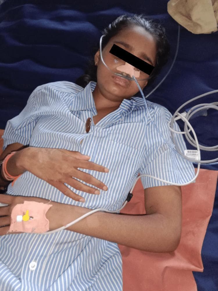 This clinical photograph shows a young female patient in a supine position, illustrating the resolution phase of generalized edema (anasarca). The patient exhibits a visible reduction in swelling around the facial region, specifically the periorbital and lip areas, compared to a state of acute exacerbation. Clinical support is evident via a nasal cannula for supplemental oxygen and a peripheral intravenous (IV) catheter secured on the dorsal aspect of the left hand. Notable dermatological findings include patches of hypopigmentation or depigmentation on the right forearm and wrist. The image serves as an educational representation of the clinical response to corticosteroid therapy in a pediatric patient with systemic swelling. The patient's upper extremities show improved anatomical definition in the fingers and wrists, indicative of successful diuresis or resolution of interstitial fluid accumulation. The image captures the patient's status post-treatment for progressive body swelling and dysphagia, demonstrating partial recovery of normal tissue contours.