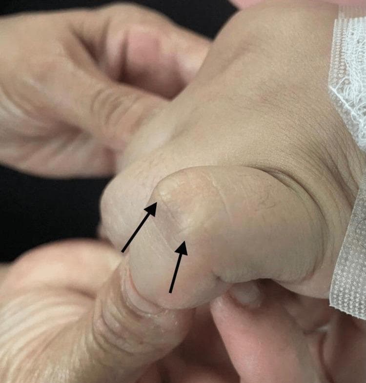 Clinical photograph showing the dorsal surface of a human hand, specifically focusing on the interphalangeal joints. Two prominent subcutaneous nodules are visible over the joint space, indicated by black arrows. These nodules appear as firm, well-circumscribed, painless elevations under the skin. They are flesh-colored to slightly pale, with smooth overlying skin and no signs of acute inflammation, erythema, or ulceration. This finding is a characteristic major Jones criterion for the diagnosis of acute rheumatic fever. The image serves as an educational tool for identifying extra-articular manifestations of rheumatological and post-streptococcal conditions in a clinical setting.