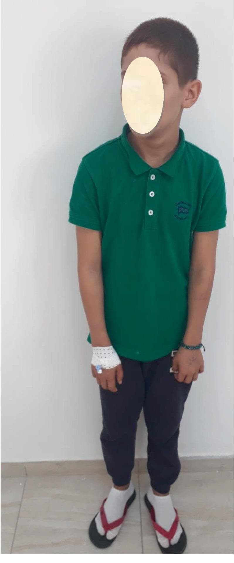 This clinical photograph shows a full-body view of a 10-year-old male patient presenting with physical manifestations suggestive of Fanconi anemia (FA). The most prominent clinical feature is short stature, with the patient appearing significantly smaller than expected for his chronological age. Visible dermatologic findings include generalized skin pallor, likely related to underlying anemia, and several hyperpigmented macules consistent with 'café au lait' spots on the arms and facial region. The patient's right hand is secured with a white compression bandage and an intravenous (IV) catheter, indicating active clinical management or hematologic intervention. Educational focus is placed on the recognition of constitutional features of inherited bone marrow failure syndromes, specifically the triad of short stature, characteristic skin pigmentation, and developmental anomalies in a pediatric hematology context.