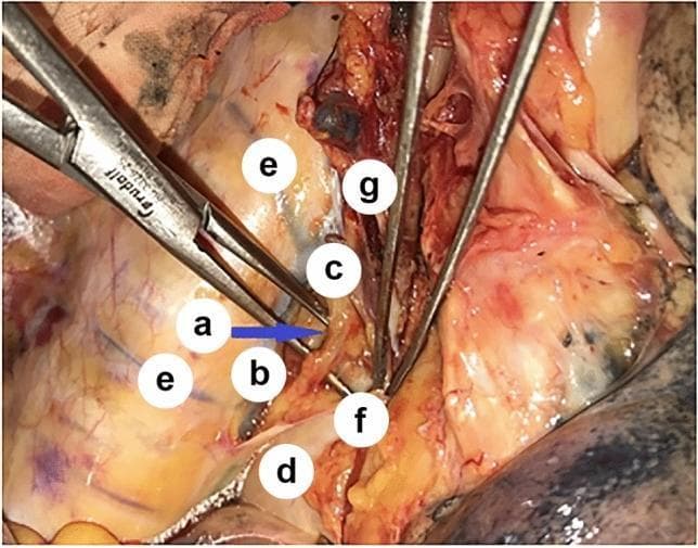 This clinical photograph provides an intraoperative view of the posterior mediastinum during a surgical procedure, specifically highlighting the anatomical relationships surrounding the azygos venous system and the thoracic duct. The image demonstrates the thoracic duct (a) being carefully isolated and elevated by a surgical dissector, appearing as a thin, translucent, yellowish vessel. Anatomical landmarks include the azygos vein (b) and the arch of the azygos vein (c) positioned laterally. The esophagus (d) is visible deep to the reflected mediastinal pleura (f). Posteriorly, intercostal veins (e) are seen draining into the azygos system. Also visible are branches of the vagal nerve (g) providing innervation in the periesophageal region. This image is educational for thoracic surgery and surgical anatomy, illustrating the critical proximity of the thoracic duct to the azygos vein and esophagus, which is essential for preventing intraoperative lymphatic injury during esophagectomy or mediastinal lymphadenectomy.