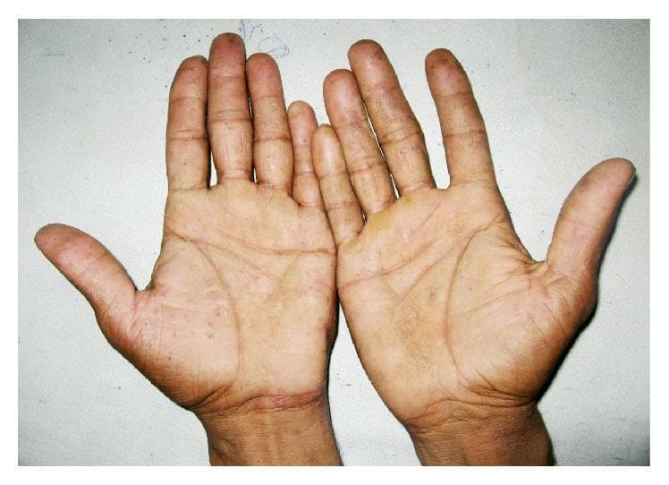 Clinical photograph of both palms demonstrating multiple, small, deep-seated vesicles symmetrically distributed across the palmar surfaces and digits. The lesions are characteristic of chronic vesiculobullous hand dermatitis, also known as dyshidrotic eczema or pompholyx. The vesicles appear as translucent, firm, 'tapioca-like' elevations primarily concentrated on the palms and the lateral aspects of the fingers. The surrounding skin exhibits mild xerosis (dryness) and accentuation of skin markings, with focal areas of post-inflammatory hyperpigmentation. There is no evidence of secondary bacterial infection or prominent erythema. The bilateral and symmetrical involvement is a key clinical sign used to differentiate this condition from contact dermatitis or fungal infections (tinea manuum). This image serves as a diagnostic reference for primary inflammatory hand eczemas in a clinical dermatology setting.