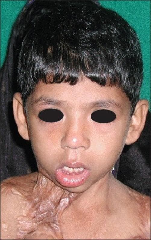 Clinical photograph of a pediatric patient (approximately 5 years old) presenting with a severe, recurrent post-burn contracture (PBC) of the neck and upper chest. The affected area exhibits extensive hypertrophic scarring and keloid-like tissue formation, characterized by irregular, raised textures and varying hyperpigmentation ranging from pink to deep reddish-brown. The contracture significantly affects the cervicomental angle and sternomental distance, causing a downward traction on the lower facial structures. Visually, this is manifested as an eversion or pulling down of the lower lip (ectropion of the lip), resulting in a partially open mouth and blunting of the mandibular definition on the affected side. The image illustrates the complex secondary deformities associated with severe burn sequelae in the head and neck region, specifically the functional and aesthetic impact of scar contracture on facial symmetry and range of motion. It serves as an educational example for plastic and reconstructive surgery planning, highlighting the challenges of managing recurrent scarring in pediatric burn patients.