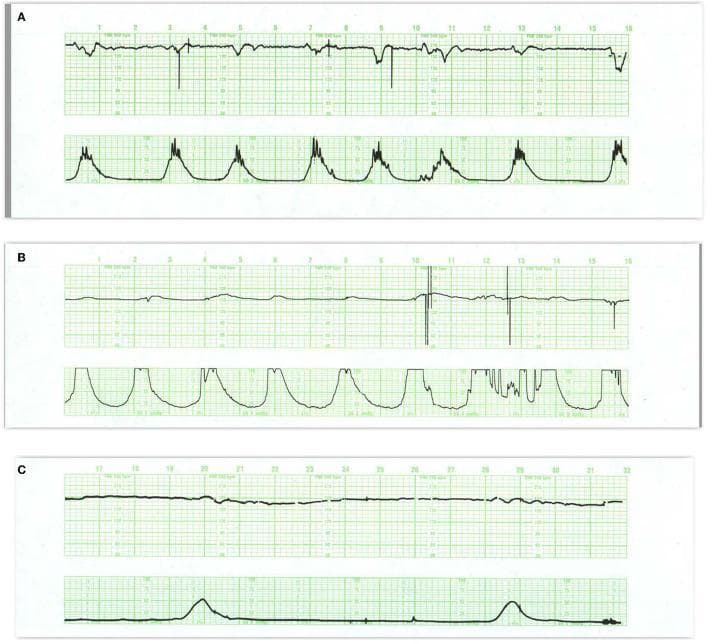 This diagnostic image displays a three-panel cardiotocogram (CTG) used for electronic fetal monitoring during labor. The panels (A, B, and C) demonstrate fetal heart rate (FHR) tracings (top rows) and uterine contraction activity (bottom rows).
Panel A illustrates fetal tachycardia (baseline >160 bpm) with diminished short-term variability, showing small variable decelerations followed by 'overshoot' accelerations, typically seen in maternal febrile conditions. Panel B depicts a stable FHR baseline during the second stage of labor, characterized by frequent uterine contractions and maternal pushing without significant decelerations, indicating normal neurological control. Panel C reveals a pathological tracing featuring sustained baseline tachycardia, minimal variability, and small variable decelerations with compensatory overshoots and an unstable baseline following contractions.
The horizontal scale represents time (16 minutes per panel), and the vertical scale for FHR is 30 bpm/cm. These tracings illustrate key obstetric concepts, including the differentiation between resilient fetal responses and ominous patterns suggestive of potential fetal infection or hypoxic-ischemic distress.