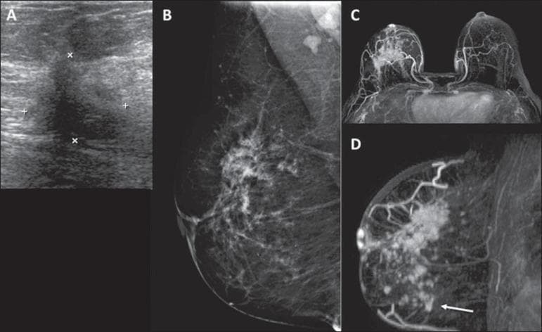 This composite diagnostic image illustrates breast cancer staging using multiple modalities including ultrasound (A), mammography (B), and contrast-enhanced MRI (C, D). Image A (ultrasound) displays an irregular, hypoechoic solid mass in the upper outer quadrant, characterized by ill-defined borders and acoustic shadowing, marked by calipers. Image B (mammogram) shows a corresponding focal asymmetry and architectural distortion in the right breast. Images C and D are Maximum Intensity Projection (MIP) MRI scans demonstrating extensive contrast enhancement. While ultrasound and mammography localized the primary tumor, the MRI reveals a significantly larger area of malignant involvement, including satellite lesions extending into the lower quadrants (indicated by an arrow in D). This comparison highlights the clinical significance of MRI in accurately assessing tumor extent and identifying multicentric or multifocal disease that may be occult on conventional imaging. Target educational concepts include breast imaging BIRADS features, diagnostic modality correlation, and preoperative tumor mapping in surgical oncology.