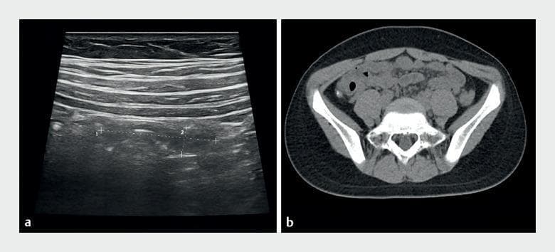 This dual-panel image demonstrates diagnostic imaging of acute obstructive appendicitis in a pediatric patient. Panel (a) is a grayscale ultrasound of the right lower quadrant, showing the abdominal wall layers and a deep, abnormal curved tubular structure. This structure features thickened, echogenic walls and internal speckling, with measurement calipers marking the diameter and length of the inflamed appendix. Panel (b) is an axial non-contrast computed tomography (CT) scan of the pelvis. It shows a cross-section of an enlarged appendix in the right lower quadrant containing multiple hyperdense (bright white) foci consistent with appendicoliths or fecaliths. The CT also highlights the surrounding soft tissue anatomy, pelvic bones (ilium, sacrum), and adjacent intestinal loops. Together, these modalities illustrate key radiological findings for appendiceal obstruction, including luminal distension, wall thickening, and the presence of obstructive high-density material.