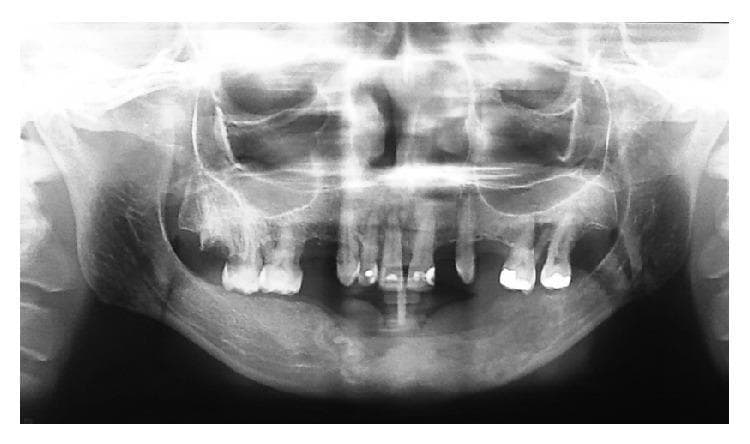 This diagnostic panoramic radiograph (orthopantomogram) displays a postoperative view of the mandible following the treatment of a central ossifying fibroma (COF). The image demonstrates a large, well-circumscribed lesion involving the anterior and left posterior mandible, extending from the right lateral incisor (tooth 41) to the left second molar region. The lesion exhibits a mixed radiopaque-radiolucent internal structure, characteristic of fibro-osseous lesions where mineralized tissue replaces normal bone. Key dental findings include evident radicular resorption of tooth 41 and the absence of several teeth in the affected mandibular quadrants. The radiograph, taken 12 months post-enucleation and curettage, shows the surgical site with no immediate signs of aggressive recurrence. The maxillary structures, including the maxillary sinuses and nasal cavity, appear within normal limits. This image serves as an educational example of the radiographic presentation and long-term follow-up of benign but expansive odontogenic tumors in oral and maxillofacial surgery.