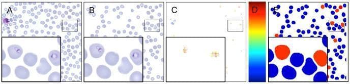 This composite educational graphic illustrates an automated diagnostic workflow for detecting malaria (Plasmodium falciparum) in human blood smears. The sequence transitions from raw clinical imaging to final automated classification. Panel A shows a Giemsa-stained thin blood film with erythrocytes and potential parasites. Panel B demonstrates the candidate segmentation phase, where individual red blood cells are isolated from the background. Panel C presents a diagnostic heat map generated by a sliding-window support vector machine (SVM) classifier, where colored pixels represent the probability of infection. Panel D provides the heat map scale, ranging from blue (low probability) to red (high probability). Panel E shows the final binary classification result, with infected erythrocytes color-coded in red and uninfected cells in blue. Each panel includes a magnified inset to highlight morphological details, such as trophozoite ring stages. This image demonstrates the application of computer-aided detection (CAD) in parasitology for calculating parasitemia levels in hematological samples.
