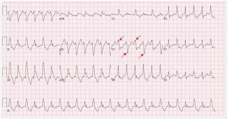 A 12-lead electrocardiogram (ECG) demonstrating bidirectional ventricular tachycardia (BVT), a rare and serious cardiac arrhythmia. The tracing shows a rapid ventricular rate with wide QRS complexes, indicating an ectopic ventricular origin. A hallmark feature of BVT is captured here: beat-to-beat alternation of the QRS axis. This is most prominently highlighted in lead V2 with red arrows, which point to the alternating positive and negative (anterior and posterior) deflections of successive QRS complexes. There is an absence of discernible P waves, consistent with atrioventricular dissociation or a rhythm originating below the AV node. The rhythm is slightly irregular but maintains the characteristic alternating morphology throughout the limb and precordial leads. This finding is classically associated with digitalis toxicity, catecholaminergic polymorphic ventricular tachycardia (CPVT), or severe structural heart disease, representing significant electrical instability.