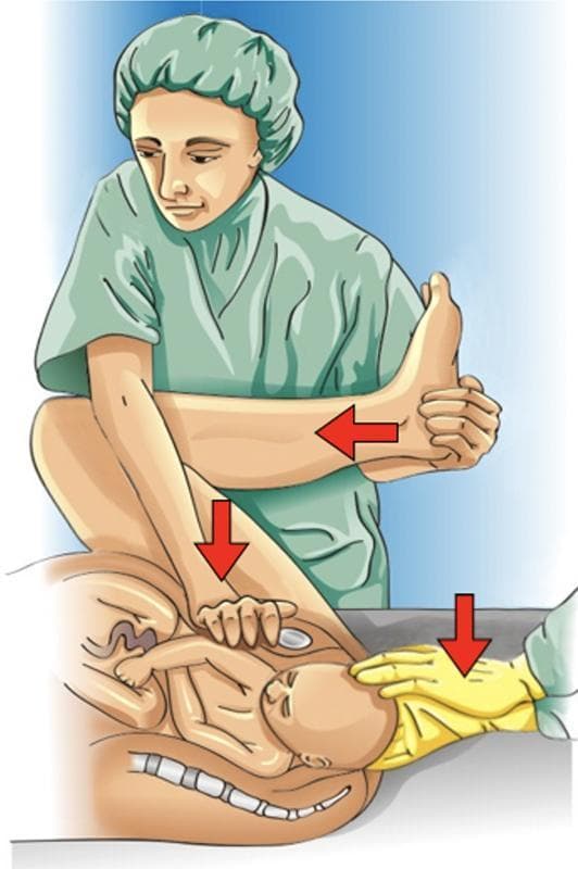 This medical illustration depicts the simultaneous application of the McRoberts maneuver and Rubin I maneuver to resolve shoulder dystocia during childbirth. The diagram shows the maternal pelvis in a sagittal cross-section with the fetus in a cephalic presentation. The McRoberts maneuver is demonstrated by the hyperflexion of the maternal thighs against the abdomen, indicated by a red arrow pointing toward the mother's chest; this action flattens the sacral promontory and rotates the symphysis pubis cephalad. Simultaneously, the Rubin I maneuver is illustrated by an assistant applying firm suprapubic pressure in an inferomedial direction (indicated by a vertical red arrow) to encourage the impaction of the anterior fetal shoulder to resolve. A third red arrow indicates the clinician applying gentle downward traction on the fetal head. The illustration serves as an educational tool for obstetric emergencies, highlighting the vector of forces and maternal positioning required to increase the functional diameter of the pelvis and facilitate delivery of the impacted shoulder.