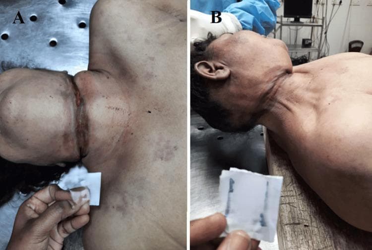 Clinical photograph from a forensic autopsy showing two views (A and B) of a ligature mark on the neck of a deceased adult. View A displays the anterior aspect of the neck, revealing a well-defined, horizontal, and incomplete ligature furrow located above the level of the thyroid cartilage. The mark is reddish-brown with a parchment-like, depressed appearance, indicating focal pressure. View B shows the lateral aspect of the neck, illustrating the oblique and ascending trajectory of the mark as it travels toward the point of suspension. The surrounding skin exhibits postmortem changes, but the mark itself is clearly demarcated and does not encircle the neck completely, a finding consistent with typical hanging. These images are used in forensic medicine to demonstrate classic external signs of mechanical asphyxia, highlighting the morphology, location, and directionality of ligature marks essential for determining the mechanism and manner of death.