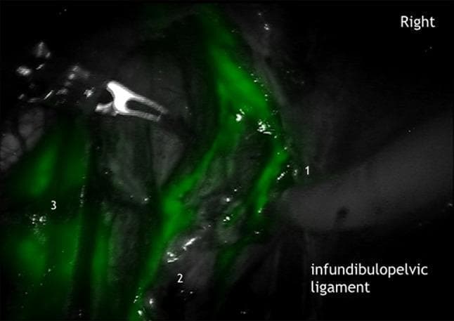 This intraoperative clinical photograph demonstrates Indocyanine Green (ICG) fluorescence imaging used for real-time lymphography during a surgical procedure. The image depicts the mesonephric lymphatic drainage pathways within the female pelvic anatomy. Bright green linear fluorescence highlights active lymphatic trunks tracking along the right ovarian vein (labeled 1) and the right ovarian artery (labeled 2). These vessels are seen within the infundibulopelvic ligament, indicating the transport of lymphatic fluid from the uterine corporal sub-compartment toward higher nodes. A more diffuse and concentrated area of fluorescence is visible in the common iliac lymph basin (labeled 3), representing a primary drainage station. This visualization assists in identifying the mesonephric pathway to para-aortic nodes, distinguishing it from the pelvic pathways. The use of ICG here facilitates precise anatomical mapping of sentinel lymph nodes and lymphatic networks in oncological or gynecological surgery, allowing for better identification of the Müllerian and mesonephric compartments.