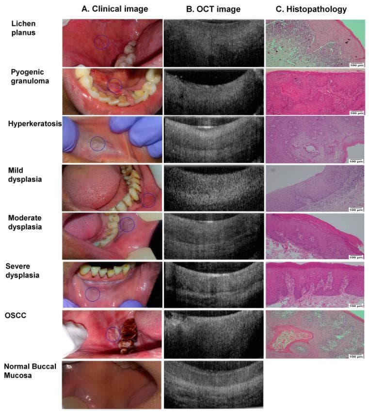 A multi-modal comparison chart displaying clinical photographs (column A), Optical Coherence Tomography (OCT) scans (column B), and histopathology slides (column C) for a spectrum of oral cavity conditions. The rows categorize findings into: non-dysplastic lesions (Lichen planus, Pyogenic granuloma, Hyperkeratosis), progressive stages of dysplasia (mild, moderate, and severe), Oral Squamous Cell Carcinoma (OSCC), and normal buccal mucosa. Clinical images show various presentations including white lacy patches, reddish nodules, and ulcerated masses. OCT cross-sections demonstrate progressive loss of tissue stratification and increased epithelial thickness or signal disruption associated with malignant transformation. Histopathology (Hematoxylin and Eosin stain, 100x magnification) provides the definitive diagnosis, showing structural changes such as epithelial thickening, cellular atypia, and basement membrane disruption in severe dysplasia and OSCC. This diagnostic panel illustrates the correlation between non-invasive imaging modalities and gold-standard biopsy results in the detection and grading of oral premalignant and malignant lesions.
