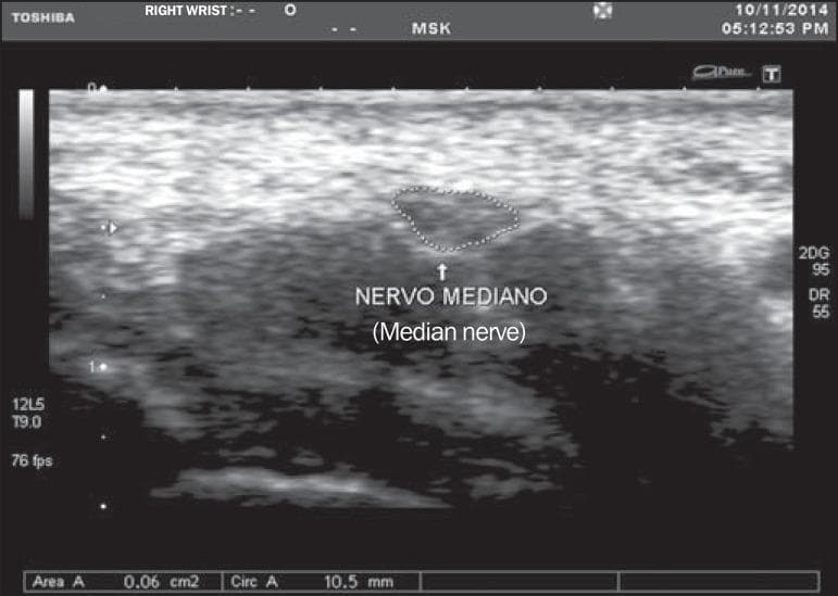 This diagnostic ultrasound image displays a transverse cross-section of the median nerve at the level of the proximal flexion fold of the wrist. The median nerve is visualized as a relatively hypoechoic, oval structure positioned superficial to the flexor tendons. A manual trace delineation (dotted line) identifies the median nerve area (MNA) for morphometric analysis. Quantitative data at the bottom of the frame indicates a cross-sectional area of 0.06 cm² (6 mm²) and a circumference of 10.5 mm. The surrounding musculoskeletal anatomy includes the more echogenic, fibrillar patterns of adjacent tendons and soft tissues. This imaging modality is primarily used in the diagnostic workup for Carpal Tunnel Syndrome (CTS), where an increase in MNA (typically ≥ 9 mm²) serves as a key sonographic marker for nerve compression. The image represents a standard musculoskeletal (MSK) ultrasound protocol using a high-frequency linear transducer to assess peripheral nerve morphology.