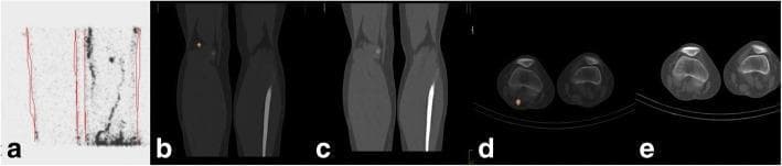 A multi-panel diagnostic imaging series demonstrating sentinel lymph node (SLN) localization in a patient with malignant melanoma of the right foot. (a) Planar lymphoscintigraphy of the right popliteal region showing diffuse radiotracer uptake and faint lymphatic channels. (b) Sagittal SPECT/CT fusion image of the popliteal region, providing high-contrast localization of a single focal SLN within the posterior leg anatomy. (c) Corresponding sagittal low-dose CT alone, displaying the anatomical structures of the knee and lower limb without tracer data. (d) Axial SPECT/CT fusion image clearly identifying the SLN located posteriorly to the popliteal fossa. (e) Axial low-dose CT at the same level showing cross-sectional musculoskeletal anatomy of both knees. The comparison highlights the clinical advantage of hybrid SPECT/CT over planar lymphoscintigraphy for precise 3D anatomical mapping and surgical planning during sentinel node excision (SLNE) for cutaneous melanoma.