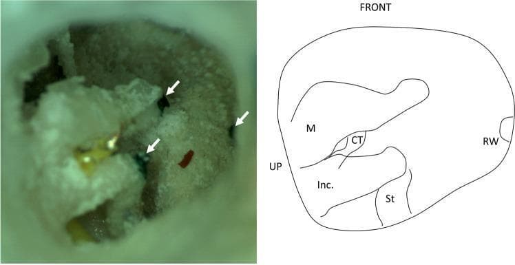 This composite image consists of an otoendoscopic clinical photograph (left) and a corresponding anatomical line diagram (right) of a right human temporal bone in an operative position. The photograph illustrates a qualitative analysis of microneedle injection accuracy within the middle ear cleft. Three target areas are identified by black ink droplets (marked with white arrowheads) and one red ink droplet, serving as markers for localization. The anatomical diagram provides orientation, labeling key structures of the middle ear: the malleus (M), incus (Inc.), stapes (St), chorda tympani (CT), and the round window (RW) niche. The view is oriented with 'FRONT' and 'UP' markers, simulating a surgical approach through the external auditory canal. The visible bone surface displays a textured, porous morphology characteristic of the mastoid/tympanic region. This visual material is designed for educational use in otolaryngology, specifically regarding surgical navigation, augmented reality systems in ear surgery, and middle ear anatomy.