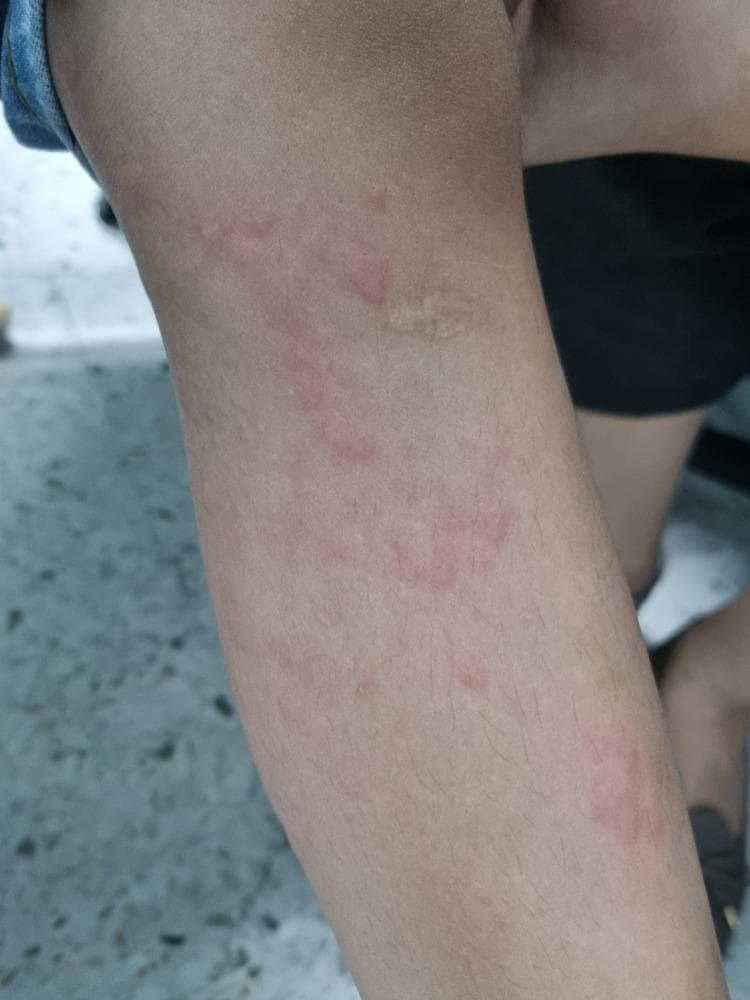 A clinical photograph showing a close-up of a child's lower extremity demonstrating urticaria. The image displays multiple raised, edematous skin lesions known as wheals or hives. These lesions are characterized by pale-to-skin-colored central swellings of varying sizes and irregular shapes, surrounded by a distinct zone of erythema (redness). The distribution is scattered across the leg, illustrating the typical appearance of a hypersensitivity reaction or allergic response. This image serves as an educational reference for identifying cutaneous manifestations of urticaria, focusing on the morphology of superficial dermal edema and associated inflammatory flare.