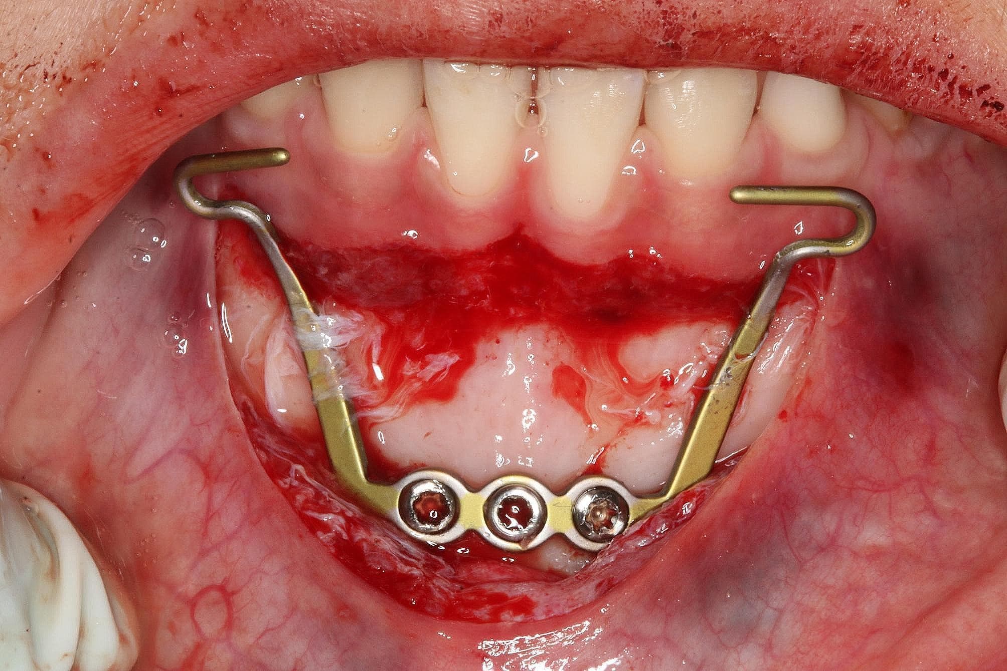 An intraoral clinical photograph showing the surgical placement of a titanium miniplate (MP) for orthodontic skeletal anchorage in the mandibular anterior region. The image demonstrates a horizontal incision within the attached gingiva of the lower incisors, with a mucoperiosteal flap elevated to expose the underlying alveolar bone. A titanium miniplate is rigidly fixed to the bone surface using three self-drilling mini screws. The appliance features two transmucosal extensions that emerge bilaterally and terminate in hooks directed mesially, designed for the attachment of intermaxillary elastics. The surgical field exhibits active hemostasis with visible blood and serum on the exposed bone and surrounding soft tissue. This educational image illustrates the anatomical positioning and primary fixation of skeletal anchorage devices (TADs) used in maxillofacial surgery and orthodontics to provide stable force for tooth movement.