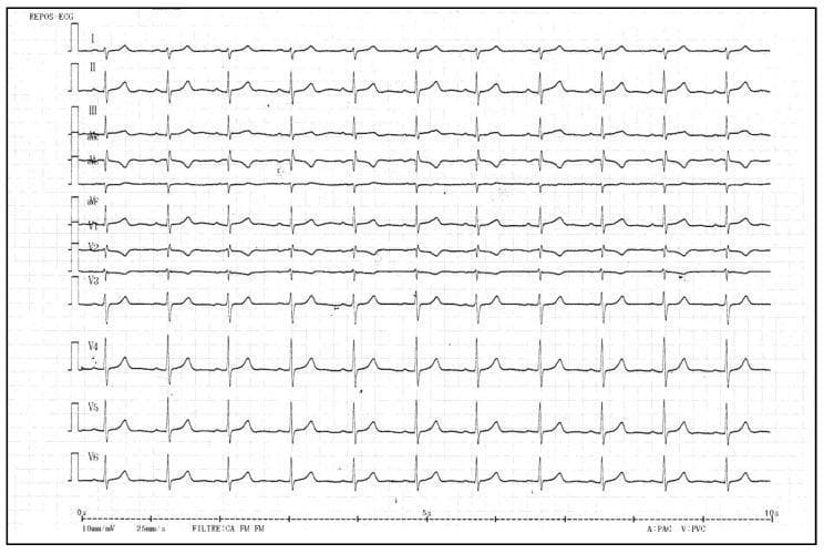 A standard 12-lead resting electrocardiogram (ECG) printed on grid paper, displaying limb leads (I, II, III, aVR, aVL, aVF) and precordial leads (V1-V6). The tracing shows a regular rhythm with visible P-waves, QRS complexes, and T-waves. Key clinical features include T-wave inversions specifically in the right precordial leads V1 and V2. In contrast, T-waves in the lateral precordial leads (V3-V6) and the limb leads (I, II, aVF) are upright and demonstrate normal morphology. The corrected QT (QTc) interval is reported at 432 ms, which is within the normal range. The tracing is set at a standard paper speed of 25 mm/s and voltage of 10 mm/mV. This visual is used to demonstrate cardiac repolarization patterns, where T-wave inversion in V1-V2 can be a normal variant or associated with specific cardiomyopathies such as Arrhythmogenic Right Ventricular Cardiomyopathy (ARVC) or Mitral Valve Prolapse (MVP) syndromes.