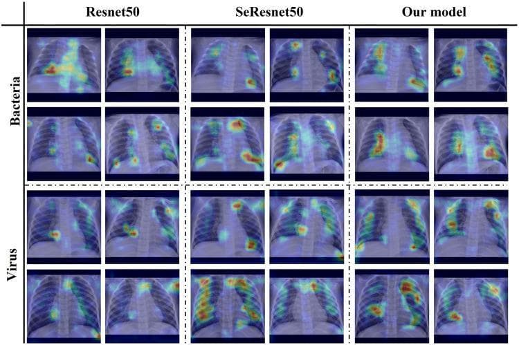 This comparison chart displays a grid of Grad-CAM attention map heatmaps superimposed on pediatric chest X-rays, demonstrating model interpretability for pneumonia classification. The visual is organized into four columns representing three different deep learning architectures: Resnet50, SeResnet50, and a proposed 'Our model'. The rows are categorized by etiology: 'Bacteria' (top two rows) and 'Virus' (bottom two rows). For each model, two representative chest X-ray cases are shown per pathology. The heatmaps use a color gradient (red being highest intensity, blue lowest) to indicate which anatomical regions the AI prioritized for its diagnosis. In bacterial pneumonia cases, 'Our model' shows highly localized, intense 'hot spots' concentrated on pulmonary consolidations compared to the more diffuse attention of Resnet50. For viral cases, the heatmaps illustrate attention distributed across bilateral lung fields, reflecting typical interstitial patterns. This image serves as a diagnostic imaging tool for researchers and medical students to understand how computer vision models identify radiological features of pediatric pneumonia.