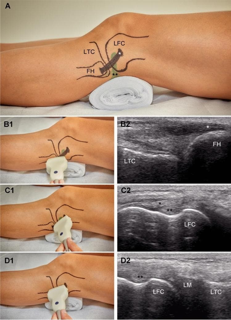 This composite educational graphic illustrates a standardized ultrasound examination protocol for assessing the lateral knee joint, specifically for measuring lateral meniscal extrusion (ME). Panel A shows a lateral clinical photograph of a knee with anatomical markings for the lateral femoral condyle (LFC), lateral tibial condyle (LTC), and fibular head (FH). Panels B1, C1, and D1 demonstrate corresponding transducer positions, while B2, C2, and D2 provide the resulting sonograms. Image B2 (Slice 1) shows the initial longitudinal plane identifying the fibular head (FH) and the lateral collateral ligament (*). Image C2 (Slice 2) shows the transducer shifted proximally to visualize the femoral attachment of the collateral ligament (*) and the popliteus tendon (**) at the LFC. Image D2 (Slice 3) displays the final measurement position at the tibiofemoral joint line, clearly depicting the relationship between the LFC, the lateral meniscus (LM), and the LTC. This standardized approach is designed to ensure consistent, reproducible measurements of meniscal displacement relative to the tibial margin in clinical and research settings.