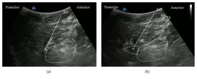 This diagnostic ultrasound comparison illustrates a posterior Quadratus Lumborum Block (QLB). Image (a) represents the pre-injection state, identifying the layered anatomy of the abdominal wall from anterior to posterior: the External Oblique (EO), Internal Oblique (IO), and Transversus Abdominis (TA) muscles. The Quadratus Lumborum (QL) muscle is outlined in the deeper plane. A white arrow indicates the needle trajectory approaching the posterior aspect of the QL. Image (b) shows the post-injection state, where the spread of local anesthetic is visualized as an anechoic (dark) fluid collection, demarcated by a white dotted line, adjacent to the QL muscle and within the lumbar interfascial triangle (LIFT). The image serves as a clinical guide for regional anesthesia, demonstrating the correct needle placement and subsequent anesthetic distribution required for effective pain management in the lumbar and abdominal regions. The orientation is labeled with posterior and anterior landmarks to aid in cross-sectional anatomical correlation.