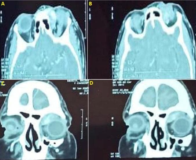This diagnostic image set consists of a contrast-enhanced computed tomography (CT) scan of the orbits in axial (panels A and B) and coronal (panels C and D) planes. The scan demonstrates a well-defined, enhancing soft tissue mass located in the superior-medial (upper internal) aspect of the left orbit. In the axial sections, the lesion is situated adjacent to the medial rectus and superior oblique muscles, causing lateral displacement of the globe and resulting in non-axial proptosis. The coronal sections confirm the superior-medial positioning of the mass and illustrate its proximity to the ethmoid sinus wall and the left frontal sinus. The lesion shows significant contrast enhancement, suggesting a vascular etiology. Anatomical landmarks of the right orbit remain normal for comparison. This imaging is characteristic of an orbital vascular tumor, such as an intravascular papillary endothelial hyperplasia (Masson tumor), and illustrates the diagnostic approach to orbital masses causing globe displacement and impaired ocular motility.