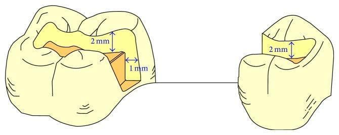 Anatomical diagram of a mandibular first molar and mandibular first premolar illustrating specific cavity preparations for a modified inlay-retained fixed partial denture (IRFPD). The diagram shows the mandibular first molar with a Class II mesial-occlusal cavity preparation and the first premolar with a Class II distal-occlusal preparation. Annotated dimensions indicate an occlusal depth of approximately 2 mm for both teeth and a proximal box depth (shoulder width) of 1 mm in the molar. The preparation design features divergent walls (approximately 6–10°) to create an unretentive form in the occlusal direction, intended to accommodate the metal framework and subsequent composite resin layering. Internal angles are rounded, and the buccolingual width is shown to be approximately 1/3 to 1/2 of the intercuspal distance. This illustration serves as a clinical guide for conservative prosthetic abutment preparation in restorative dentistry and prosthodontics.