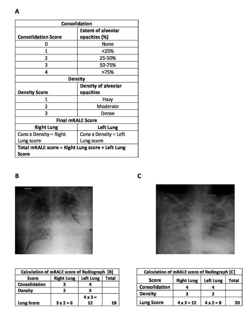 Educational infographic and diagnostic display of the modified Radiographic Assessment of Lung Edema (mRALE) scoring system used to quantify the severity of pulmonary involvement, often in cases of ARDS or severe viral pneumonia like SARS-CoV-2. Panel A contains reference tables defining two primary metrics: Consolidation Score, based on the percentage extent of alveolar opacities (0: none to 4: >75%), and Density Score (1: hazy, 2: moderate, 3: dense). It outlines the calculation formula where each lung's score is the product of consolidation and density, and the total mRALE score is the sum of both lungs. Panels B and C present clinical examples using anteroposterior (AP) chest radiographs. Panel B demonstrates bilateral opacities with a total mRALE score of 18 (Right Lung score: 3x2=6; Left Lung score: 4x3=12). Panel C shows more severe, confluent alveolar opacities with a total mRALE score of 20 (Right Lung score: 4x3=12; Left Lung score: 4x2=8). The visual serves as a standardized guide for radiological assessment and clinical research categorization.