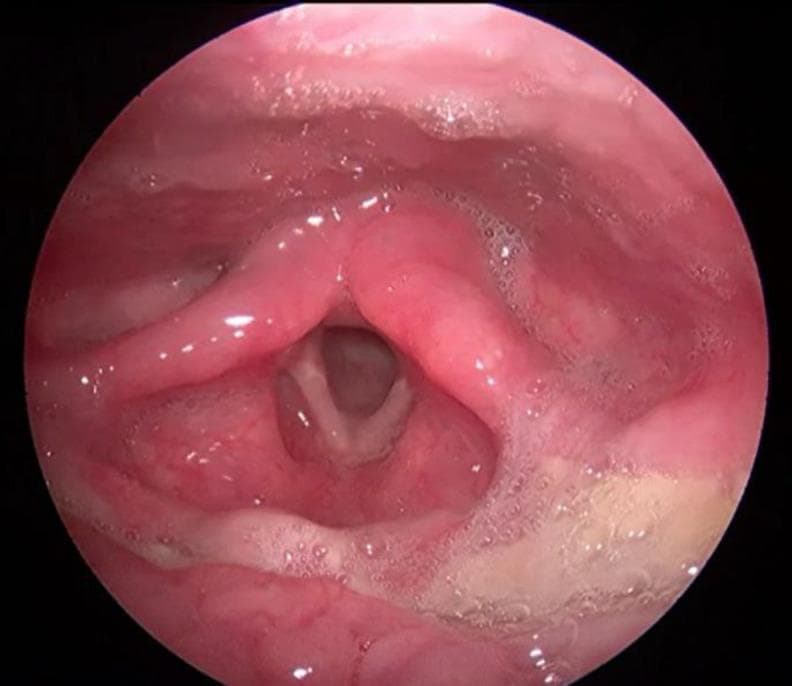 This clinical image is a frame from a video laryngoscopy showing a post-treatment view of a normal larynx in a pediatric patient. The true vocal cords (vocal folds) are clearly visualized, appearing as symmetrical, smooth, pearly-white bands that form a V-shape. The surrounding supraglottic structures, including the epiglottis, arytenoids, and false vocal cords, appear healthy with smooth, moist, pink mucosa and no evidence of edema or inflammation. The glottic opening is patent, and the vallecula and pyriform sinuses are clear of masses or lesions. This image demonstrates the resolution of a previously documented laryngeal B-cell lymphoma following chemotherapy and surgical intervention, serving as a baseline for normal laryngeal anatomy during follow-up endoscopic assessment.