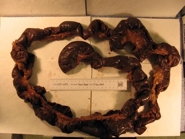 This clinical photograph displays a gross pathological specimen of a resected human small intestine, specifically demonstrating extensive full-thickness ischemic necrosis. The specimen consists of a long segment of bowel laid out on a surgical drape with a ruler for scale. The serosal surface is characterized by a diffuse, dark brown to black discoloration, indicative of gangrenous changes and tissue infarction. Visible segments show varying degrees of distension and loss of normal vascular luster, replaced by a dull, hemorrhagic appearance. Some areas reveal the associated mesentery, which also appears congested. This visual finding is a hallmark of severe mesenteric ischemia, potentially from non-occlusive mesenteric ischemia (NOMI) or vascular occlusion, leading to transmural necrosis. The image serves as a critical educational tool for identifying the gross appearance of non-viable bowel during exploratory laparotomy and understanding the progression of intestinal vascular compromise in a surgical pathology context.