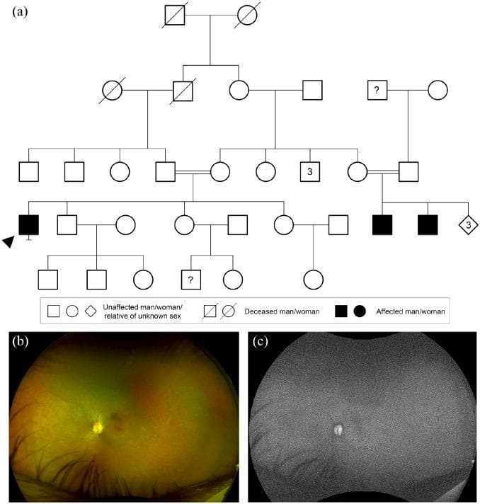 This composite figure provides a genetic and multimodal imaging analysis of retinitis pigmentosa (RP). Panel (a) is a complex consanguineous pedigree diagram illustrating an inheritance pattern associated with a homozygous RPE65 variant. Filled symbols indicate affected individuals across generations, with a double line indicating consanguinity. Panel (b) is a widefield color fundus photograph of a 42-year-old patient's right eye. It demonstrates characteristic features of retinal degeneration, including prominent retinal pigment epithelium (RPE) granularity and subtle scattered white dots, with notable pigmentation changes across the posterior pole and periphery. Panel (c) is a widefield fundus autofluorescence (FAF) image of the same eye, showing a profound and global lack of autofluorescence. This generalized hypoautofluorescence indicates severe dysfunction or loss of fluorophores in the RPE and photoreceptor layers, a hallmark finding in RPE65-related retinopathies. The combined clinical and genetic data illustrate the diagnostic correlation between inheritance patterns and progressive retinal degeneration.