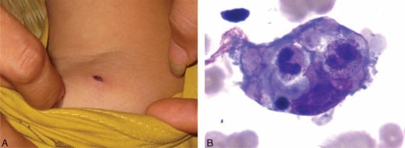 This composite image consists of two panels illustrating clinical and pathological findings associated with scrub typhus and secondary hemophagocytic lymphohistiocytosis (HLH). Panel A is a clinical photograph of a child's shoulder region showing a pathognomonic eschar: a small, oval-shaped, necrotic cutaneous lesion with a dark, crusty center and minimal surrounding erythema. Panel B is a high-power light microscopy image of a bone marrow aspirate stained with Wright-Giemsa. It demonstrates hemophagocytosis, characterized by a large activated macrophage (histiocyte) containing engulfed hematopoietic elements, including nucleated red blood cells or leukocytes, within its cytoplasm. The image serves as an educational tool for identifying the primary diagnostic cutaneous sign of rickettsial infection (Orientia tsutsugamushi) alongside its potential systemic complication, hemophagocytic syndrome.