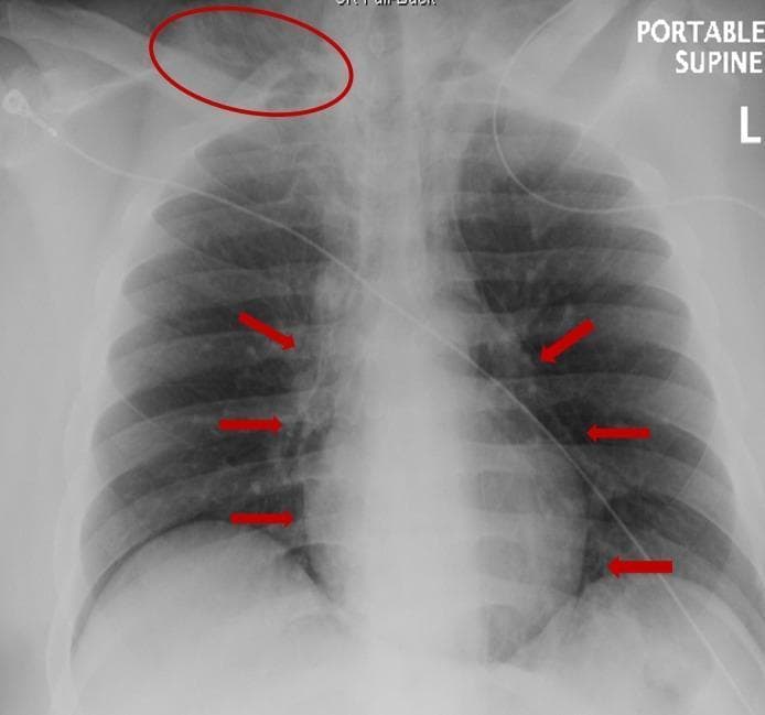 This diagnostic image is a portable supine chest radiograph (X-ray) of a human patient, categorized under clinical imaging and radiology. The image demonstrates hallmark signs of pneumomediastinum and subcutaneous emphysema. Specifically, red arrows point to linear lucencies (air) outlining the mediastinal structures and the heart border, confirming pneumomediastinum. A red circle in the right supraclavicular region highlights radiolucent streaks within the soft tissues, characteristic of subcutaneous emphysema at the right base of the neck. Clinical context suggests these findings may occur secondary to complications like esophageal rupture (Boerhaave syndrome) or diabetic ketoacidosis (DKA). The image includes medical support apparatus, such as ECG leads and potentially an enteric tube, consistent with an intensive care setting. Educational focus includes the identification of extra-alveolar air and its radiographic manifestations in critical care radiology.
