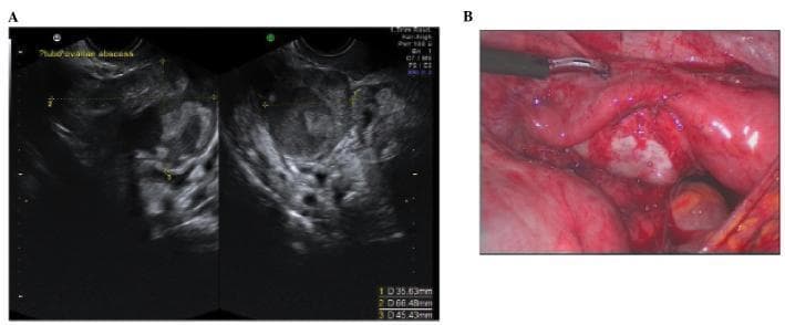 This dual-panel image provides a side-by-side comparison of a tubo-ovarian complex (TOC) using two imaging modalities. Panel A is a transvaginal ultrasound (TVUS) showing a large, heterogeneous, complex adnexal mass. The sonogram reveals mixed echogenicity with ill-defined borders, internal septations, and cystic components, indicating the involvement of both the fallopian tube and the ovary in an inflammatory process. Quantitative calipers measure the dimensions of the mass as approximately 35.6 mm x 66.5 mm x 45.4 mm. Panel B is a corresponding laparoscopic photograph of the same case, providing direct visualization of the pelvic cavity. It shows significant erythema and edema of the adnexal structures, with thick inflammatory adhesions and a whitish-yellow purulent-appearing exudate characteristic of a tubo-ovarian abscess. The laparoscopic view clarifies the anatomical distortion and tissue friability suggested by the ultrasound. This comparison illustrates the diagnostic pathway for pelvic inflammatory disease (PID) progressing to abscess formation, highlighting the correlation between sonographic heterogeneity and gross surgical inflammation.