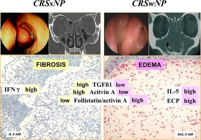 A multi-modal comparison of Chronic Rhinosinusitis without Nasal Polyps (CRSsNP) and with Nasal Polyps (CRSwNP). The image is divided into two clinical panels, each containing endoscopy, CT imaging, and histopathology. The CRSsNP panel (left) shows endoscopic nasal mucosal thickening, a coronal CT scan with ethmoid sinus opacification, and a light microscopy image (H&E, x100) labeled 'FIBROSIS'. This state is characterized by high levels of IFN̳, TGF̲1, and Activin A, and a low Follistatin/activin A ratio. The CRSwNP panel (right) displays endoscopic visualization of translucent nasal polyps, a coronal CT scan showing extensive sinus opacification, and a histopathological image (EG2, x100) labeled 'EDEMA'. It highlights eosinophilic infiltration (red staining) with high levels of IL-5 and ECP, but low TGF̲1 and Activin A. This comparison illustrates the different tissue remodeling patterns in CRS: predominant fibrosis and Th1/pro-fibrotic markers in CRSsNP versus predominant edema and Th2 markers in CRSwNP.