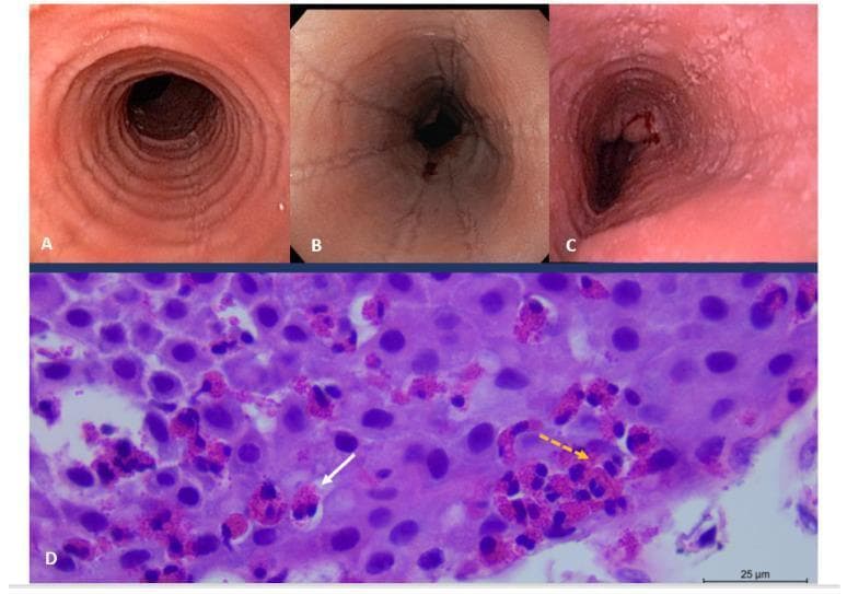 This composite educational image illustrates the diagnostic features of eosinophilic esophagitis (EoE) through endoscopy and histopathology. Upper panels (A, B, and C) display clinical endoscopic views of the esophagus. Panel A reveals trachealization, characterized by prominent circular rings. Panel B shows longitudinal linear furrows and narrowings. Panel C demonstrates mucosal fragility (crepe-paper esophagus) with visible erosions and minor surface bleeding. The lower panel (D) is a high-power light microscopy image of an H&E stained esophageal biopsy. It shows dense intraepithelial inflammation with numerous eosinophils (indicated by the dashed orange arrow), exceeding the diagnostic threshold of 15 eosinophils per high-power field. A solid white arrow points to an eosinophilic microabscess, a collection of eosinophils within the squamous epithelium. The image serves as a clinical reference for gastroenterology and pathology, highlighting the correlation between macroscopic structural changes and microscopic inflammatory infiltrates in chronic allergic esophagitis.