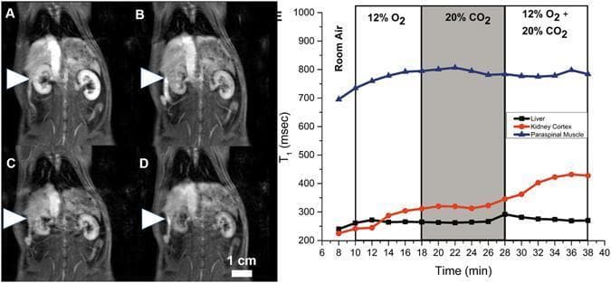 This figure demonstrates dynamic T1-weighted MRI and T1 relaxation time plots documenting microvascular responses to respiratory gas challenges in a rat model. Panels A-D display coronal T1-weighted images during a sequence of normoxia (A), hypoxia with 12% O2 (B), hypercapnia with 20% CO2 (C), and hypoxic hypercapnia (D). White arrowheads indicate the kidney cortex, which exhibits a visible decrease in signal intensity (darkening) during the hypercapnic and hypoxic hypercapnic phases compared to baseline. Panel E is a line graph showing the temporal evolution of T1 relaxation times (in milliseconds) for the liver, kidney cortex, and paraspinal muscle over a 40-minute period. The kidney cortex (orange line) shows the most significant physiological sensitivity, with T1 relaxation times increasing progressively during hypoxia and hypercapnia, reaching a peak during hypoxic hypercapnia, which correlates with vasoconstriction and reduced blood volume. In contrast, the liver (black line) and paraspinal muscle (blue line) show relatively stable T1 values across the different gas stimuli. This visual data illustrates differential organ-specific microvascular reactivity to blood gas alterations.