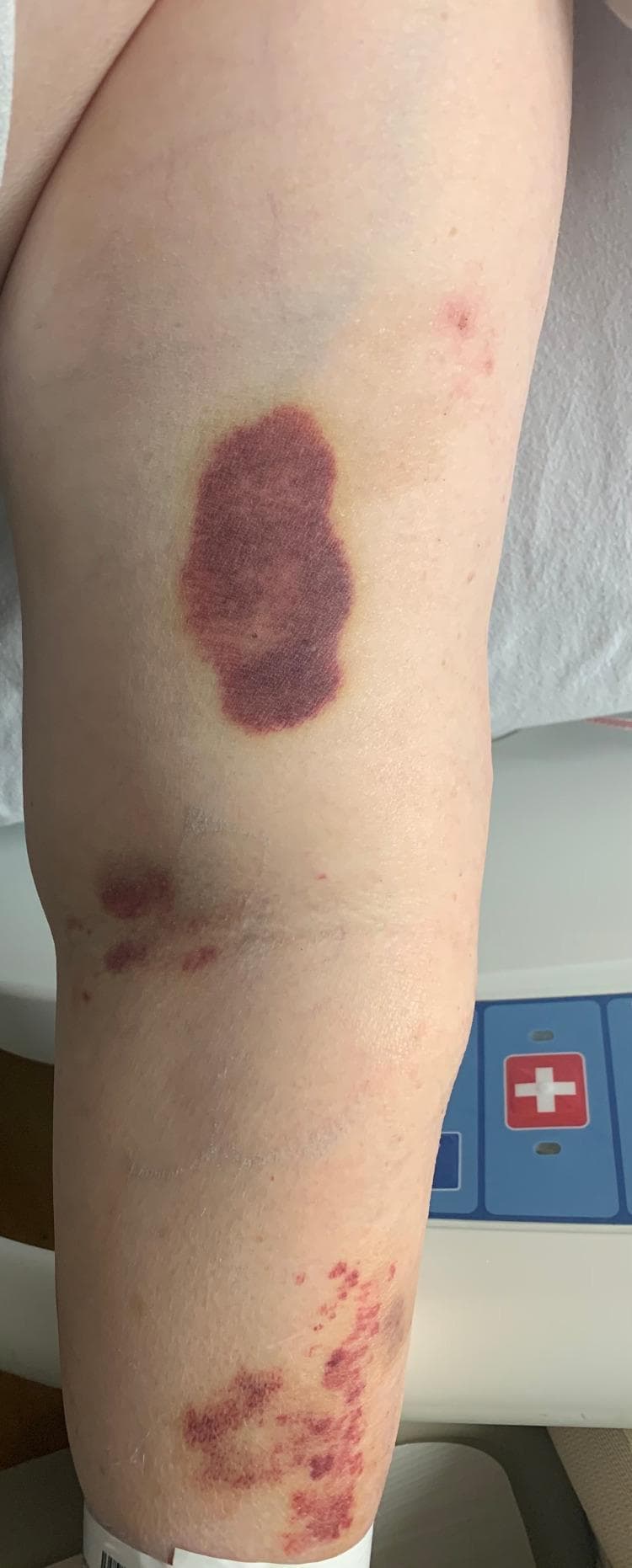 This clinical photograph displays skin lesions on a patient's extremity, consistent with a diagnosis of Immune Thrombocytopenic Purpura (ITP). The primary finding is a large, well-demarcated, oval-shaped ecchymosis (bruise) approximately 5-7 cm in length, located on the proximal limb. The lesion is deep purple to violaceous in color, indicating a recent subcutaneous hemorrhage, with a peripheral yellow-green hue suggesting hemoglobin degradation and the start of resolution. Distal to the primary ecchymosis, there are scattered clusters of petechiae (pinpoint red-purple spots) and smaller, irregular purpuric patches. These cutaneous manifestations are characteristic of a significant bleeding diathesis or severe thrombocytopenia. The distribution shows a mix of confluent ecchymoses proximally and more discrete, non-blanching petechiae distally. This image is an educational example of how a severely low platelet count manifests visually as spontaneous soft tissue bleeding and dermal hemorrhage.