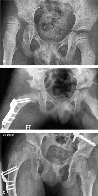 This sequence of three anteroposterior (AP) pelvic radiographs illustrates the longitudinal management of hip dysplasia in a pediatric patient with Gross Motor Function Classification System (GMFCS) level V.
Image A (Preoperative): Shows severe bilateral hip subluxation, more pronounced on the right, where the femoral head is laterally displaced with a high migration percentage (MP 67%), indicating significant lack of acetabular coverage.
Image B (1-Day Postoperative): Demonstrates immediate results following a combined right-sided femoral varus derotation shortening osteotomy (VDSO) and Dega pelvic osteotomy. A pediatric locked compression plate (LCP) and multiple screws fix the proximal femur. The pelvic osteotomy site is visible as an open wedge containing a bone graft, effectively increasing femoral head coverage.
Image C (7.4-Year Follow-up): Shows the long-term outcomes at age 14.4. There is successful remodeling and consolidation of the pelvic osteotomy site. The right hip maintains improved stability (MP 19%) with the orthopedic hardware still in situ. The left hip shows complete coverage (MP 0%). This sequence highlights the efficacy of combined bony procedures for hip stabilization in non-ambulatory cerebral palsy patients.