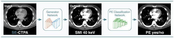 This diagram illustrates a diagnostic machine learning pipeline for automated pulmonary embolism (PE) detection. The workflow begins with an axial input image from a single-energy computed tomography pulmonary angiography (SE-CTPA), showing the thorax, heart, and pulmonary vasculature. The SE-CTPA is processed by a 'Generator Network' (a ResNet encoder-decoder) to produce a Synthetic Monoenergetic Image (SMI) at 40 keV. This SMI output demonstrates enhanced iodine attenuation and increased vascular contrast compared to the input, facilitating better visualization of potential intraluminal filling defects. The SMI is then fed into a 'PE Classification Network' (ResNet50), which performs binary classification to provide a final diagnostic result (PE yes/no). The visualization highlights the use of deep learning for domain adaptation and disease identification in radiology, specifically aiming to simulate high-contrast dual-energy CT findings from standard single-energy CT scans to improve the detection of segmental and subsegmental pulmonary emboli.