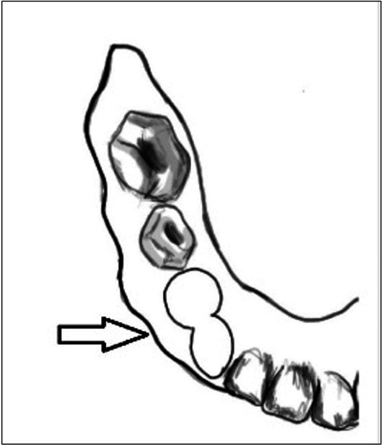 This medical illustration depicts a superior (occlusal) view of a human mandible, focusing on dental anatomy and prosthetic design. The anatomical diagram shows a sequence of posterior teeth with shaded occlusal surfaces, likely representing molars or premolars. A significant feature is an edentulous space indicated by a double-circle outline, representing missing teeth or extraction sockets. An arrow points specifically to the buccal or labial border of the mandibular bone in this region. The diagram is designed to illustrate the placement and function of a continuous or circumferential clasp used in removable partial dentures (RPDs). It demonstrates how such a clasp engages two adjacent teeth to provide a splinting effect and stabilization within the dental arch. This content is relevant for dental students and prosthodontics education, focusing on biomechanics, tooth-supported appliances, and mandibular arch restoration.