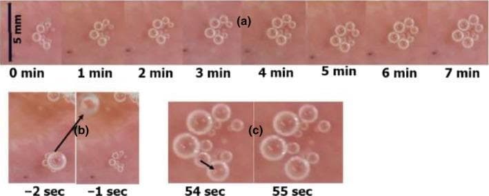 This composite of clinical photographs illustrates the dynamics of intravascular bubbles at an active hydrophobic spot (AHS) on a pulmonary vein, relevant to the pathophysiology of decompression sickness. Panel (a) presents a longitudinal series from 0 to 7 minutes post-decompression, showing a stable cluster of spherical bubbles that demonstrates gradual expansion in volume over time. Panel (b) provides a high-speed sequence showing the detachment of a large bubble (indicated by an arrow) from the vessel wall between -2 and -1 seconds, leaving behind a cleared footprint on the tissue surface. Panel (c) captures the process of coalescence at 54 to 55 seconds, where two adjacent smaller bubbles merge into a single larger bubble. The images highlight key educational concepts in diving medicine and hyperbaric physiology, specifically bubble formation (nucleation), growth via gas diffusion, and mechanical detachment into the bloodstream. A 5 mm scale bar is provided for reference.
