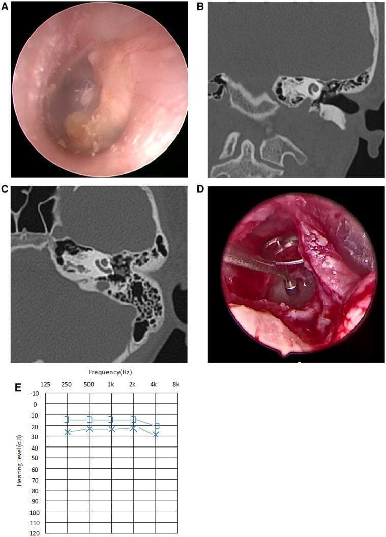 A multi-panel clinical figure documenting a case of Stage III Congenital Middle Ear Cholesteatoma (CMEC). Panel A presents an endoscopic view of the left tympanic membrane, showing a prominent, whitish, opalescent mass localized behind the eardrum, involving multiple quadrants. Panels B and C are high-resolution CT scans of the temporal bone in coronal and axial planes, respectively, demonstrating a soft tissue density filling the middle ear cavity with associated erosion or impairment of the ossicular chain, while the mastoid air cells remain well-pneumatized and uninvolved. Panel D shows an intraoperative view following cholesteatoma excision, highlighting a Total Ossicular Replacement Prosthesis (TORP) placed for hearing reconstruction due to an absent stapes superstructure. Panel E displays a postoperative audiogram showing mild conductive hearing loss with a 10 dB air-bone gap, indicating successful functional reconstruction. This composite serves as an educational tool for the diagnosis, surgical management via endoscopic ear surgery (EES), and functional outcomes of pediatric middle ear cholesteatoma.